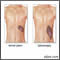 Splenomegaly