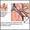 Cause of Chronic Bronchitis