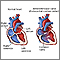 Atrioventricular canal (endocardial cushion defect)