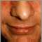Rosacea