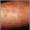 Hives (urticaria) on the arm