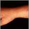 Polymorphic light eruption on the arm