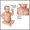 Fractured clavicle (infant)