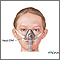 Nasal CPAP