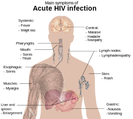 A diagram of a human torso labelled with the most common symptoms of an acute HIV infection