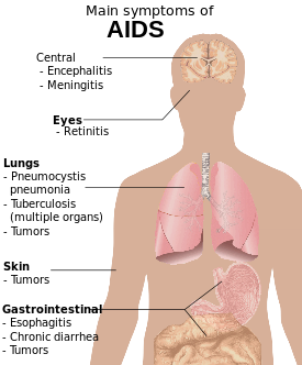 A diagram of a human torso labelled with the most common symptoms of AIDS