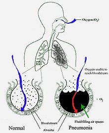 A schematic diagram of the human lungs with an empty circle on the right representing a normal alveola and one on the right showing an alveola full of fluid as in pneumonia